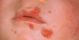 Impetigine. Come si manifesta e quali sono i rimedi